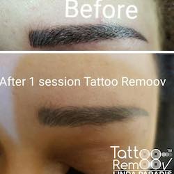 Tattoo removal 12