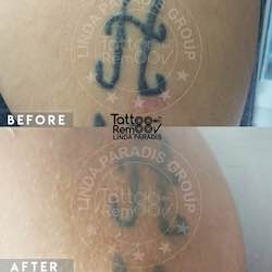 Tattoo removal 6