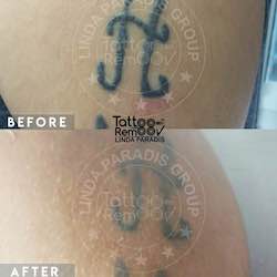 Tattoo removal 6