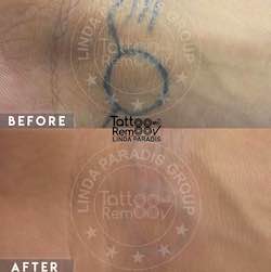 Tattoo removal 7